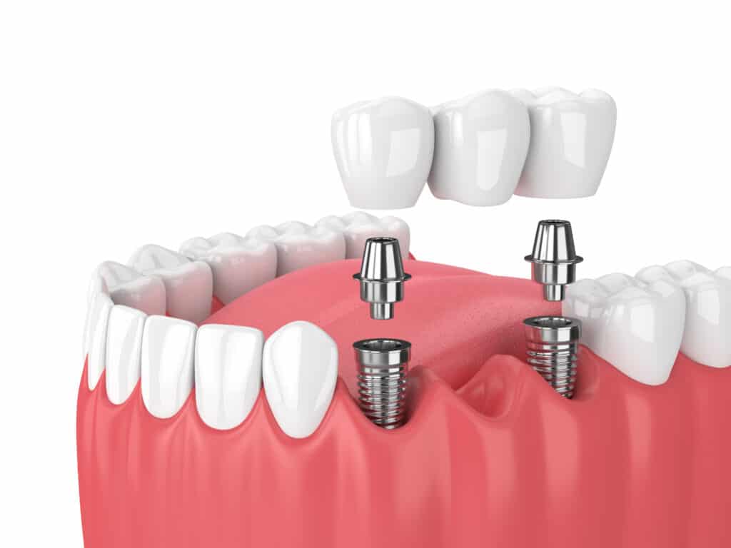 Erzincan implant tedavisi